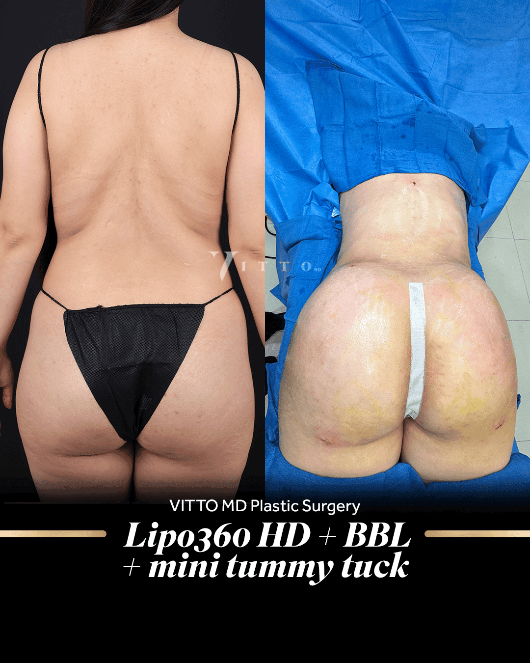 Before and after result at VittoMD in Miami, FL