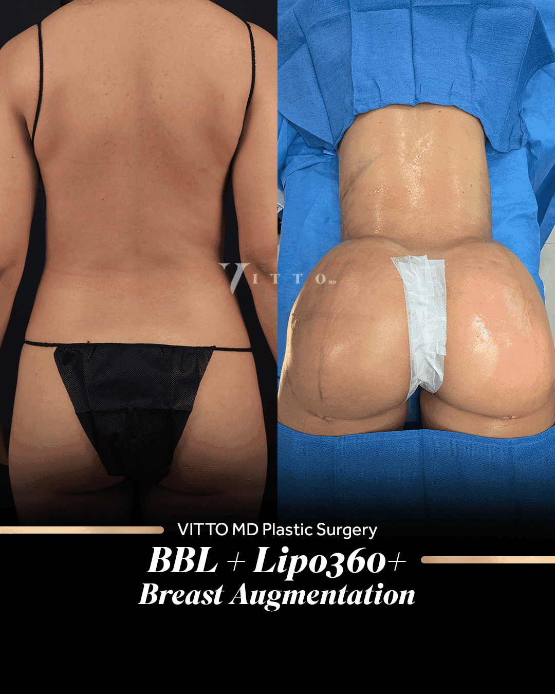 Before and after result at VittoMD in Miami, FL