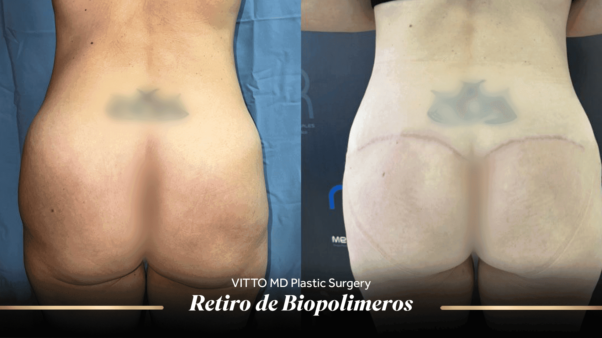 Resultados de Biopolymer Removal - 1