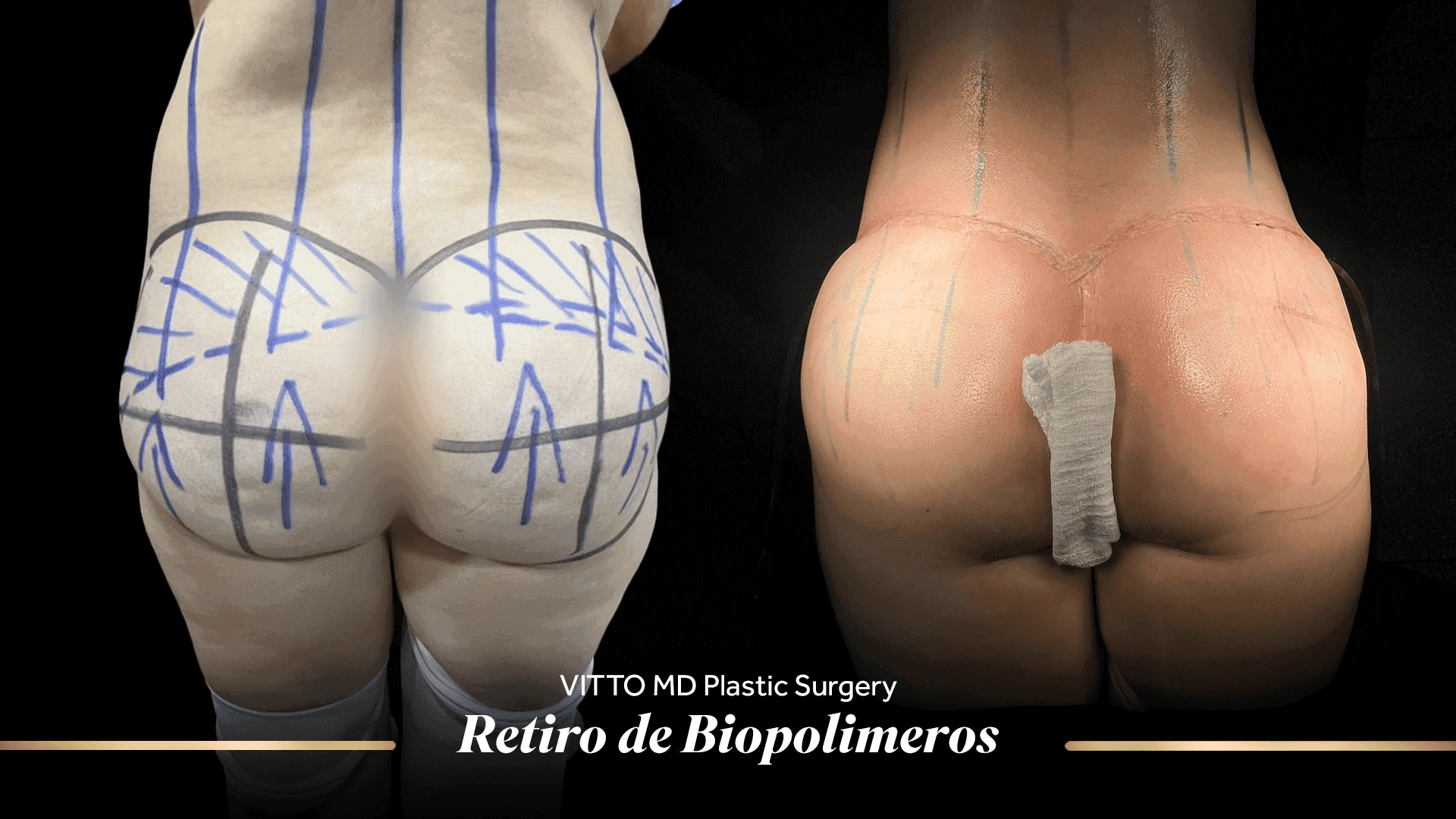 Before and after result at VittoMD in Miami, FL