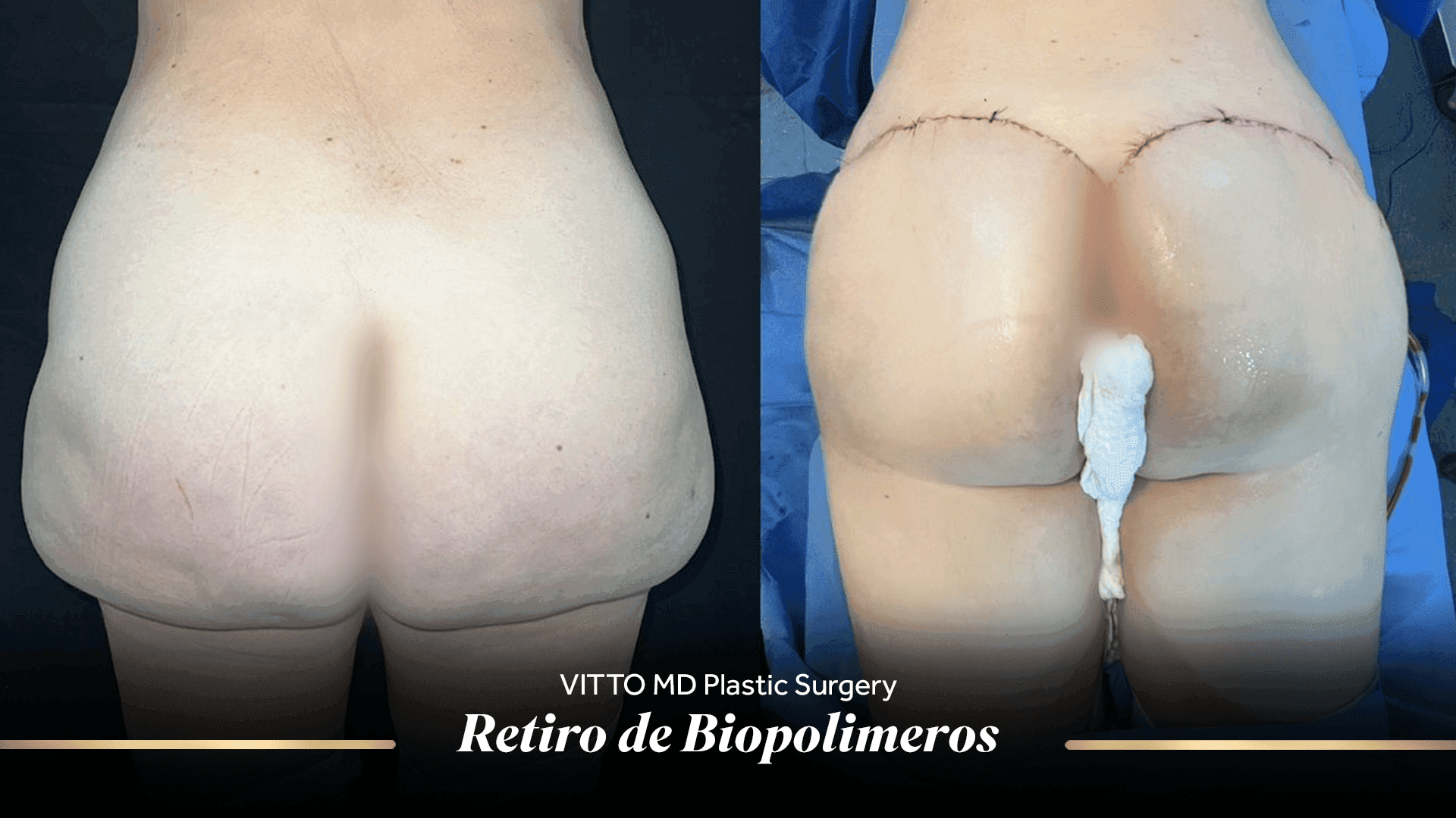Before and after result at VittoMD in Miami, FL