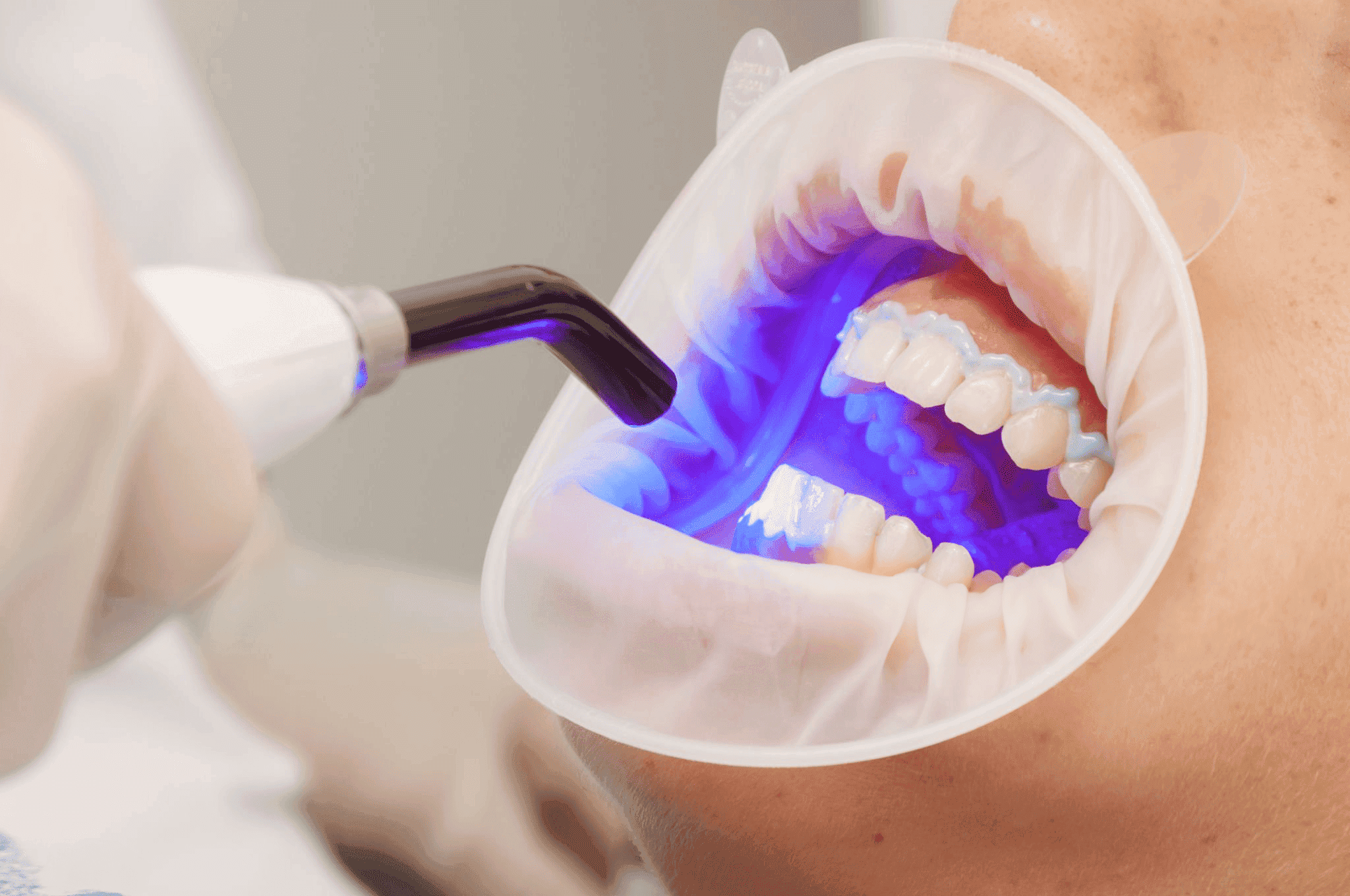 Teeth whitening