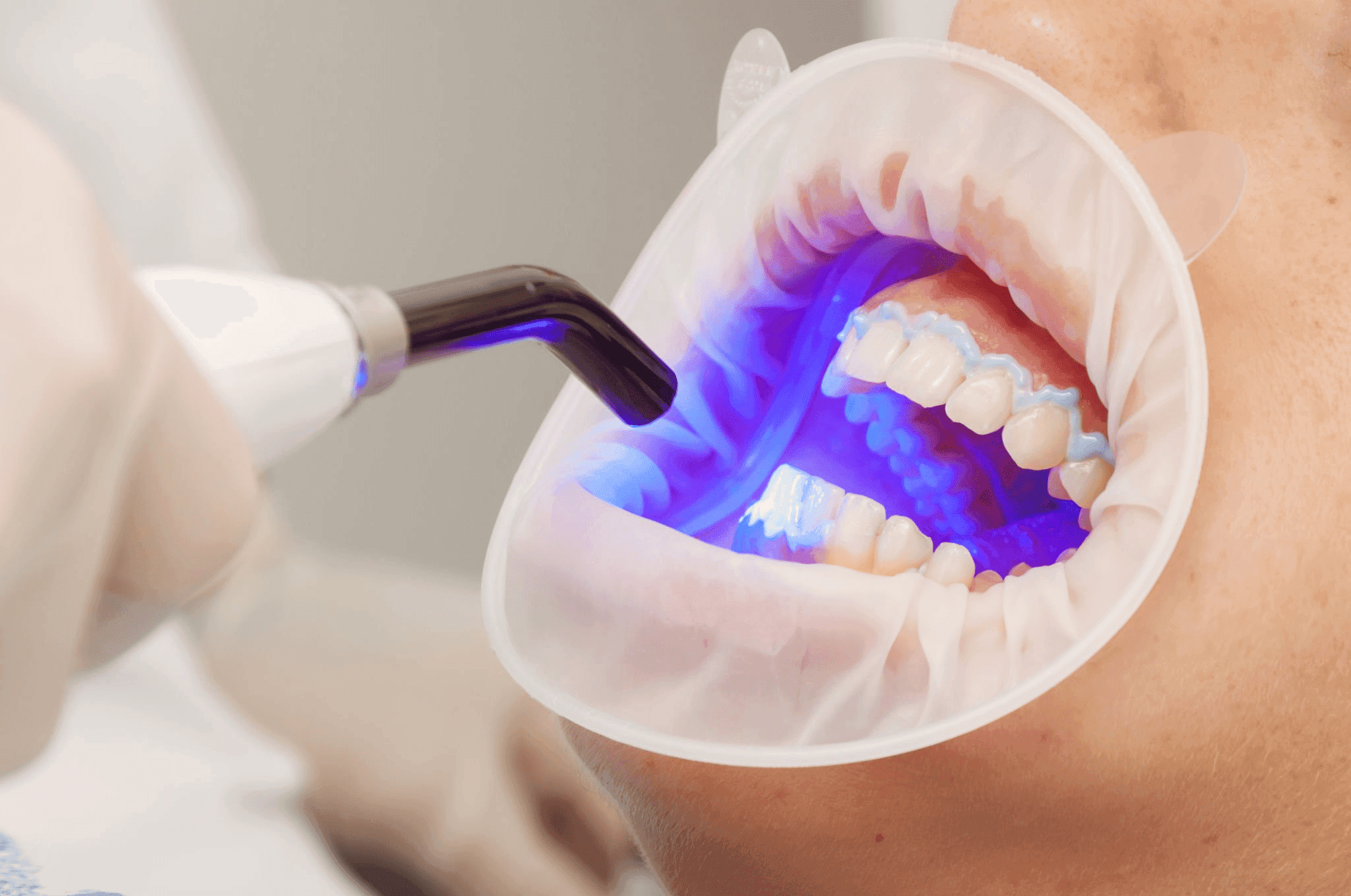 Teeth whitening