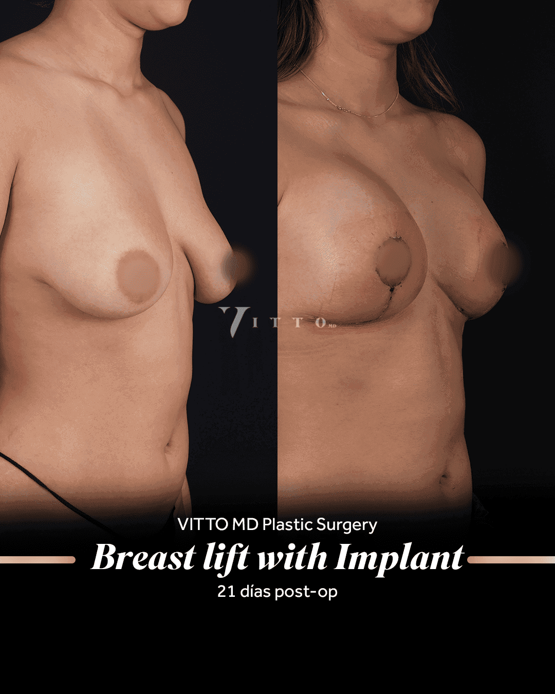 Before and after result at VittoMD in Miami, FL