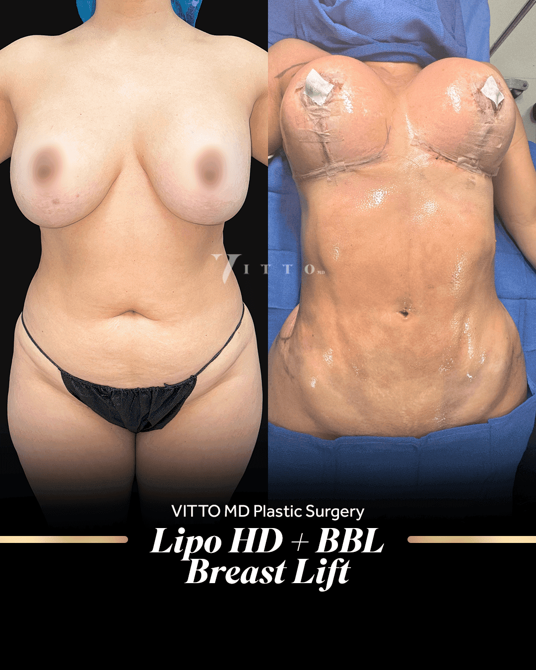 Before and after result at VittoMD in Miami, FL