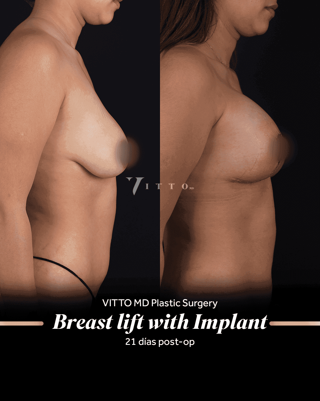 Before and after result at VittoMD in Miami, FL