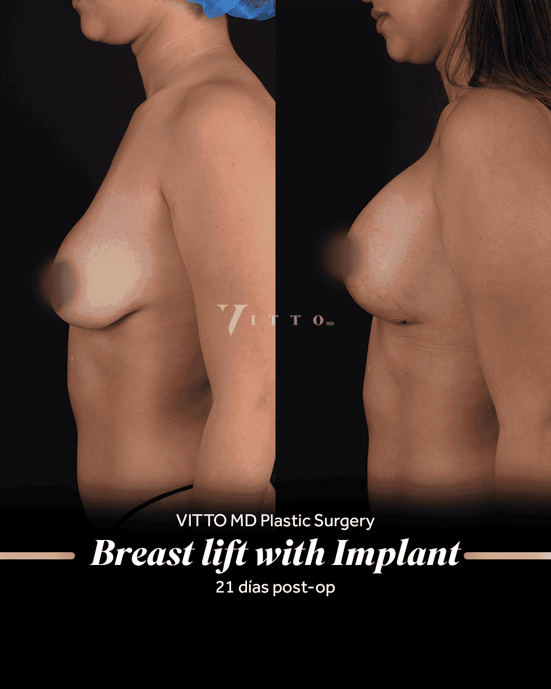 Before and after result at VittoMD in Miami, FL