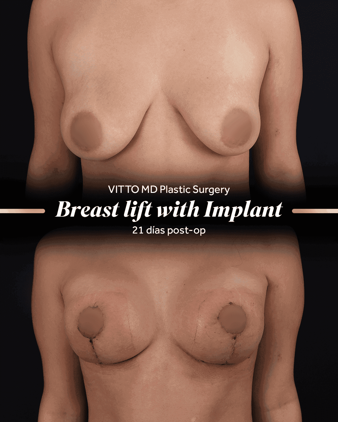 Before and after result at VittoMD in Miami, FL
