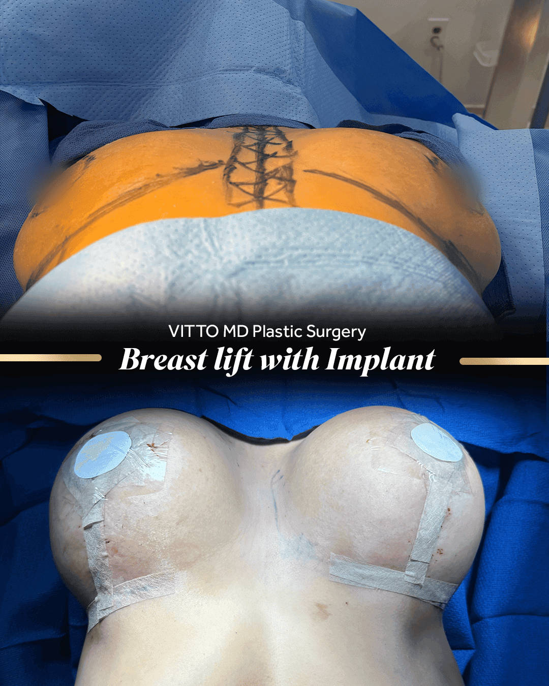 Before and after result at VittoMD in Miami, FL