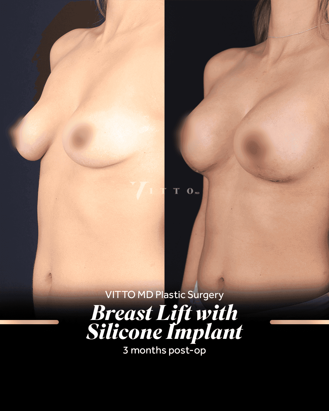 Before and after result at VittoMD in Miami, FL