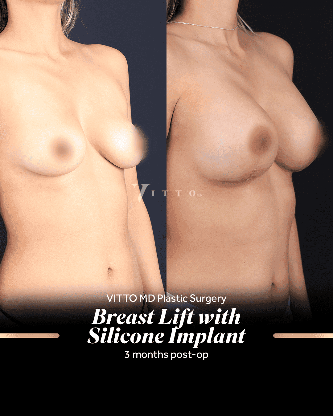 Before and after result at VittoMD in Miami, FL