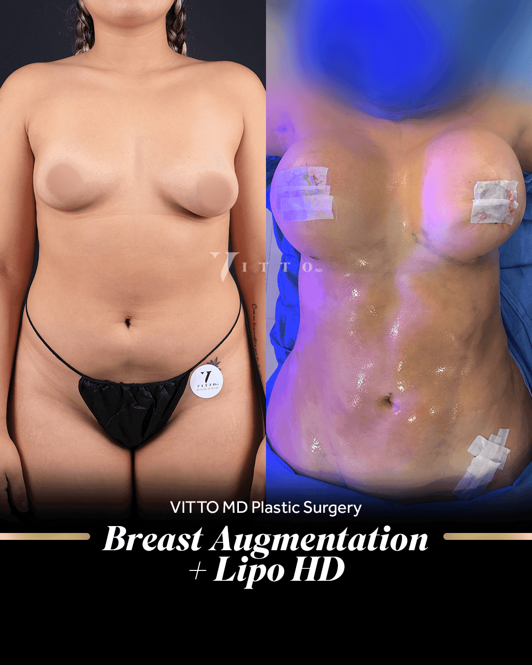 Before and after result at VittoMD in Miami, FL