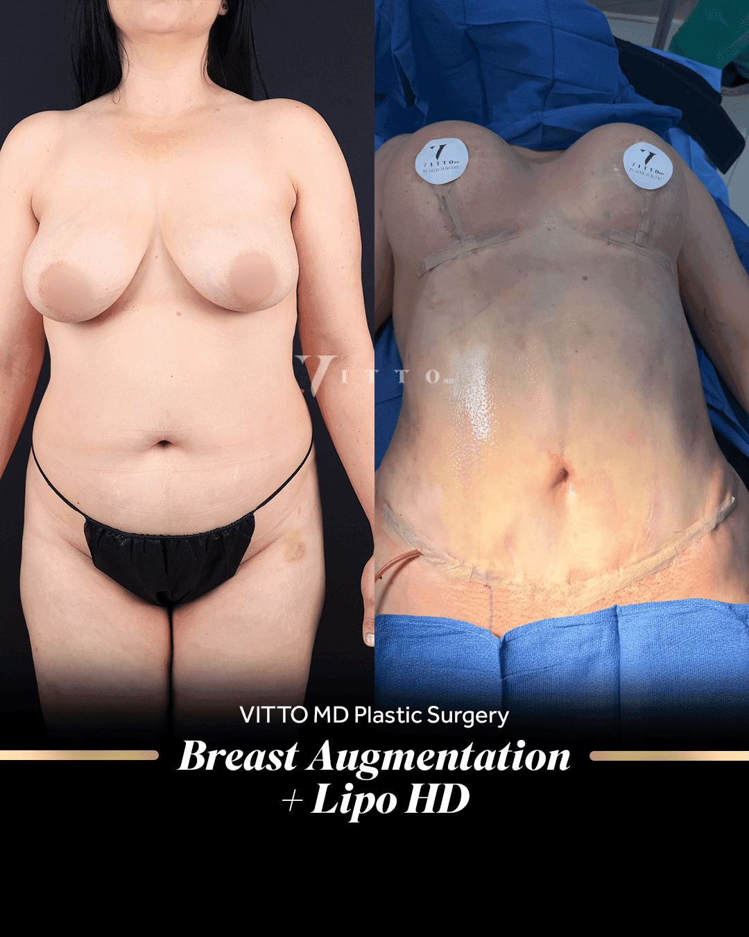 Before and after result at VittoMD in Miami, FL