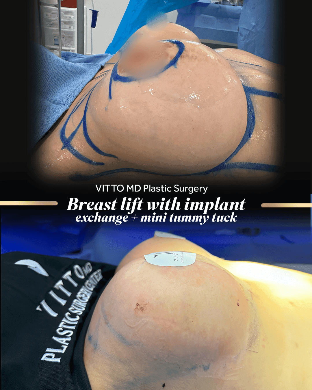 Resultados de Breast Lift - 1