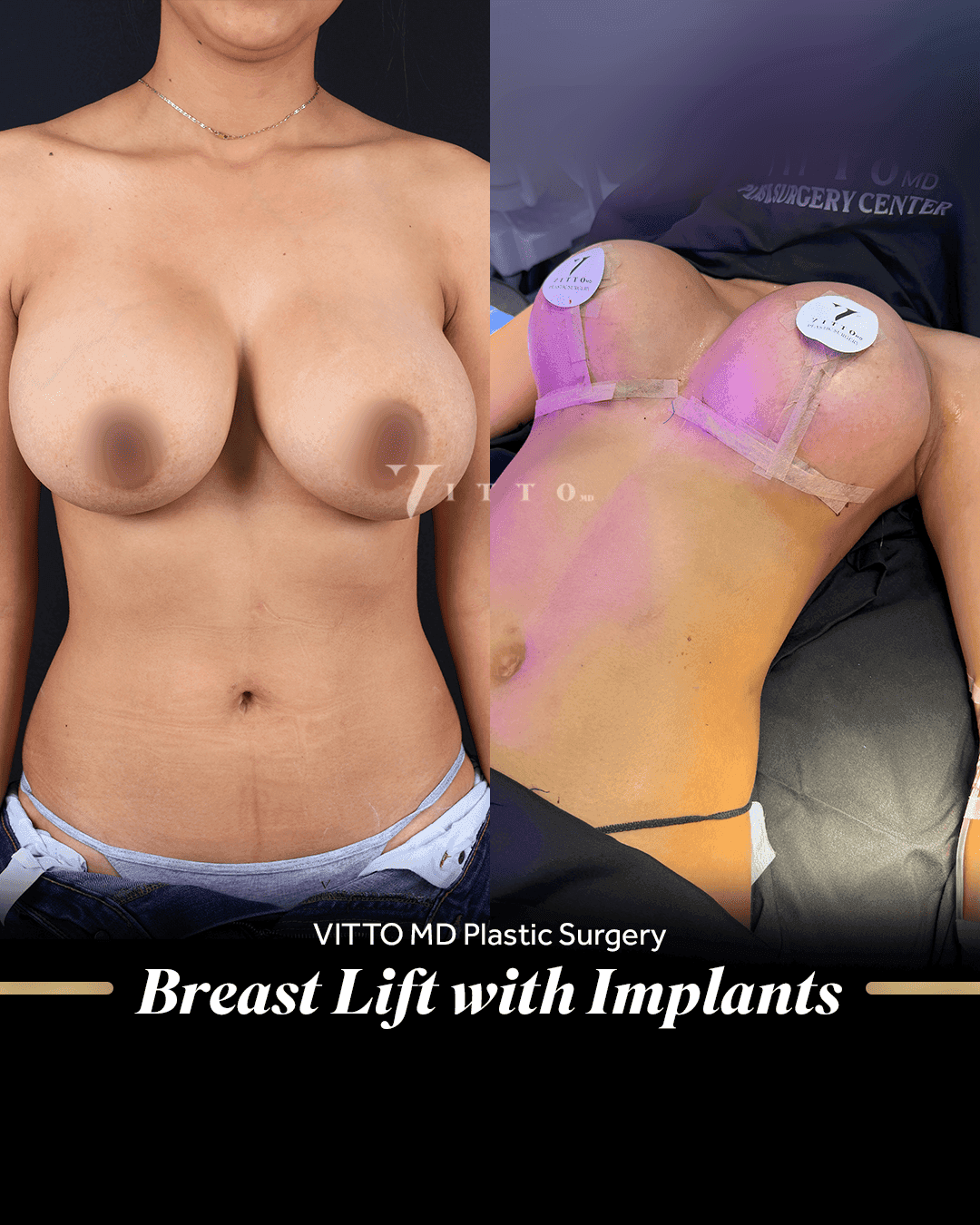 Before and after result at VittoMD in Miami, FL