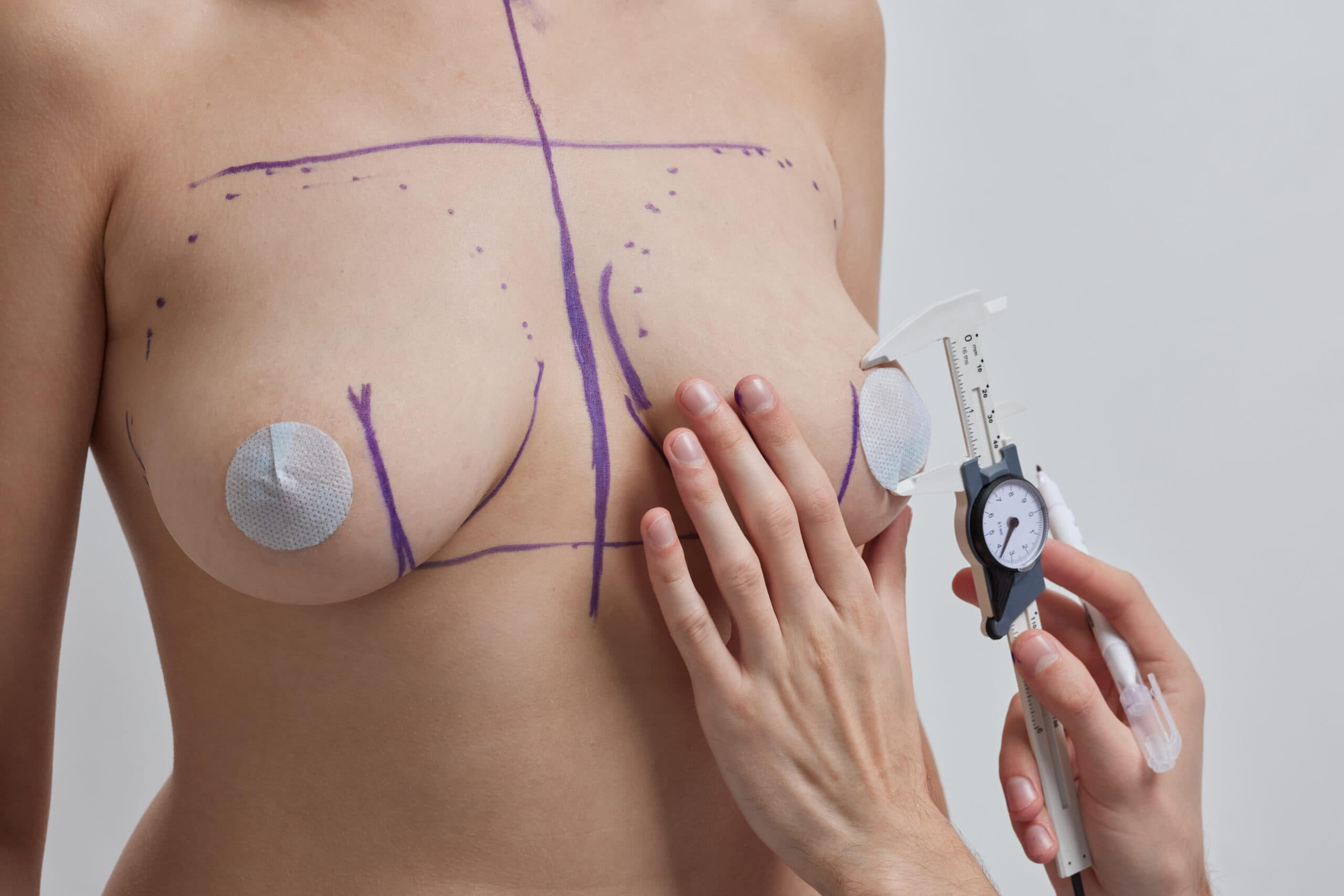 Breast Lift
