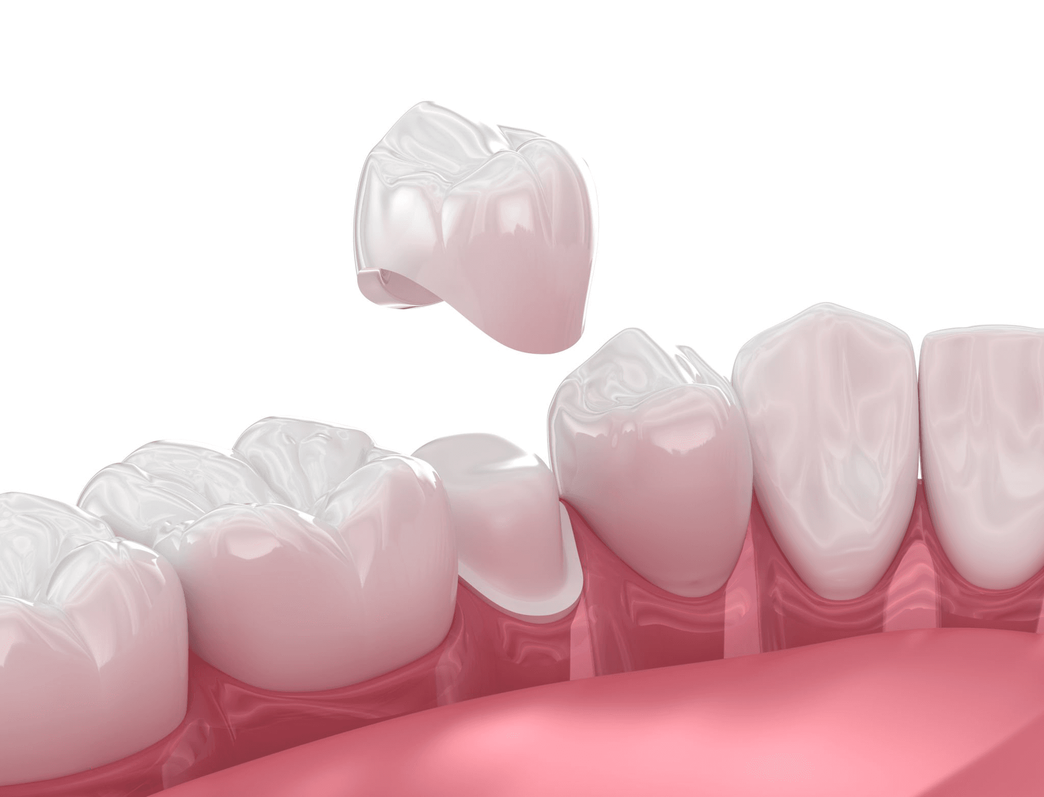Ceramic crowns