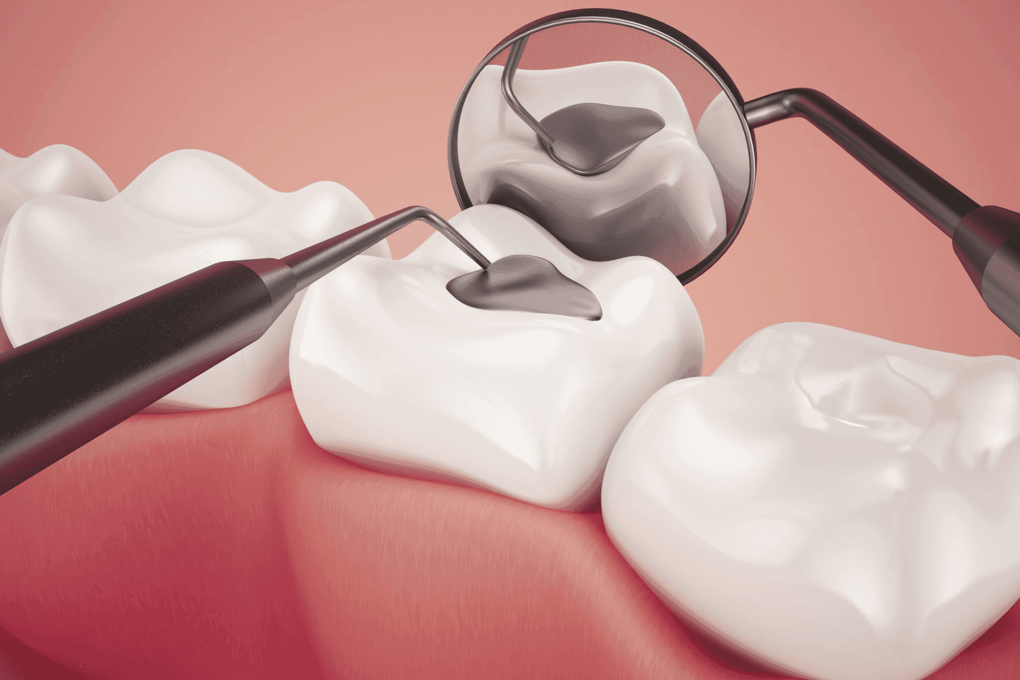 Composite white fillings