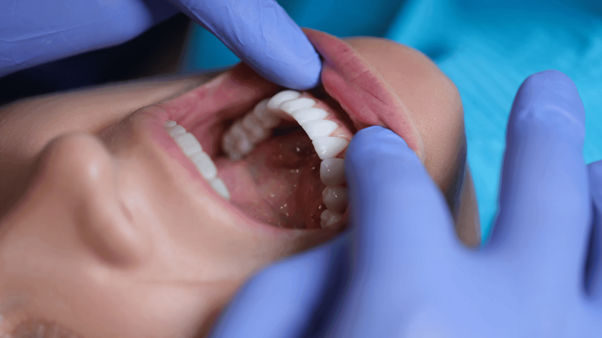Composite Veneers