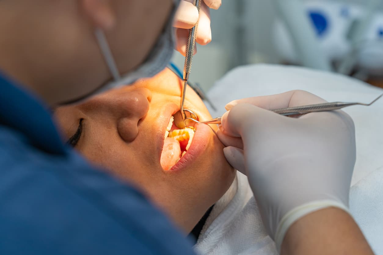 Composite white fillings