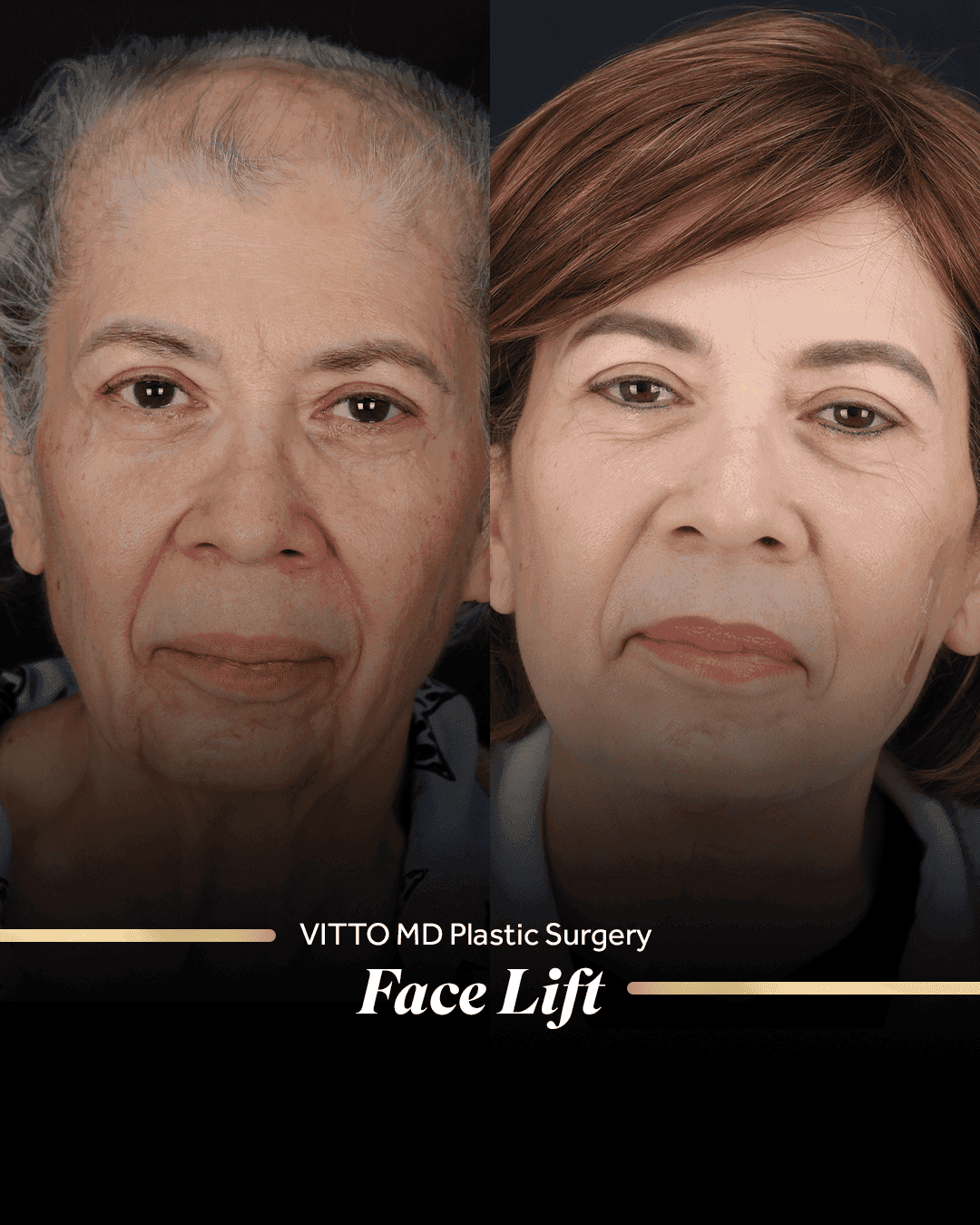 Resultados de Face Lift - 1