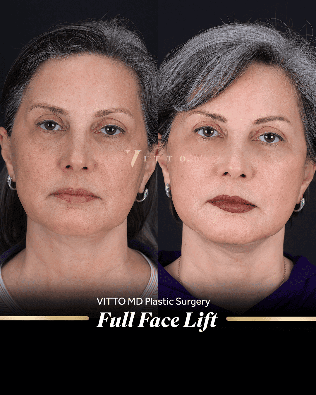 Before and after result at VittoMD in Miami, FL