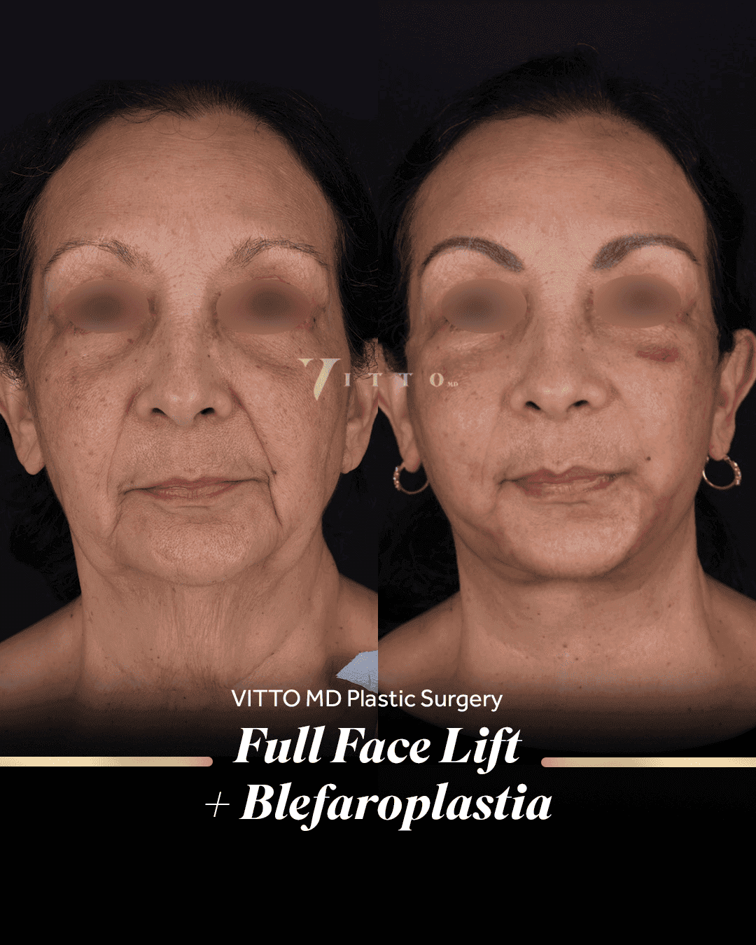 Before and after result at VittoMD in Miami, FL