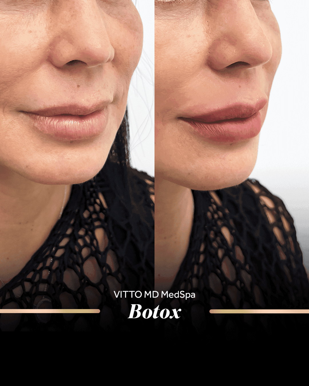 Before and after result at VittoMD in Miami, FL