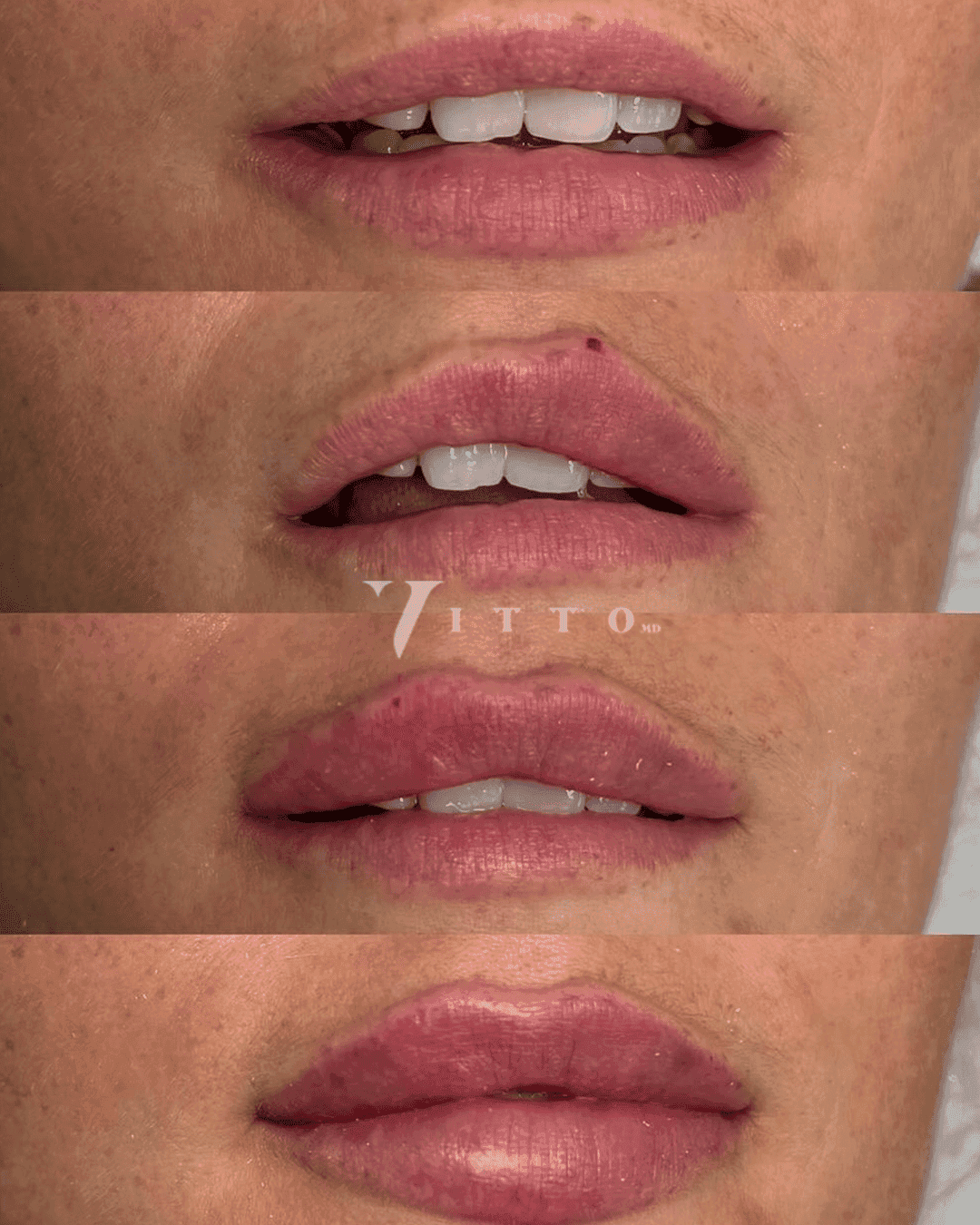 Filler
