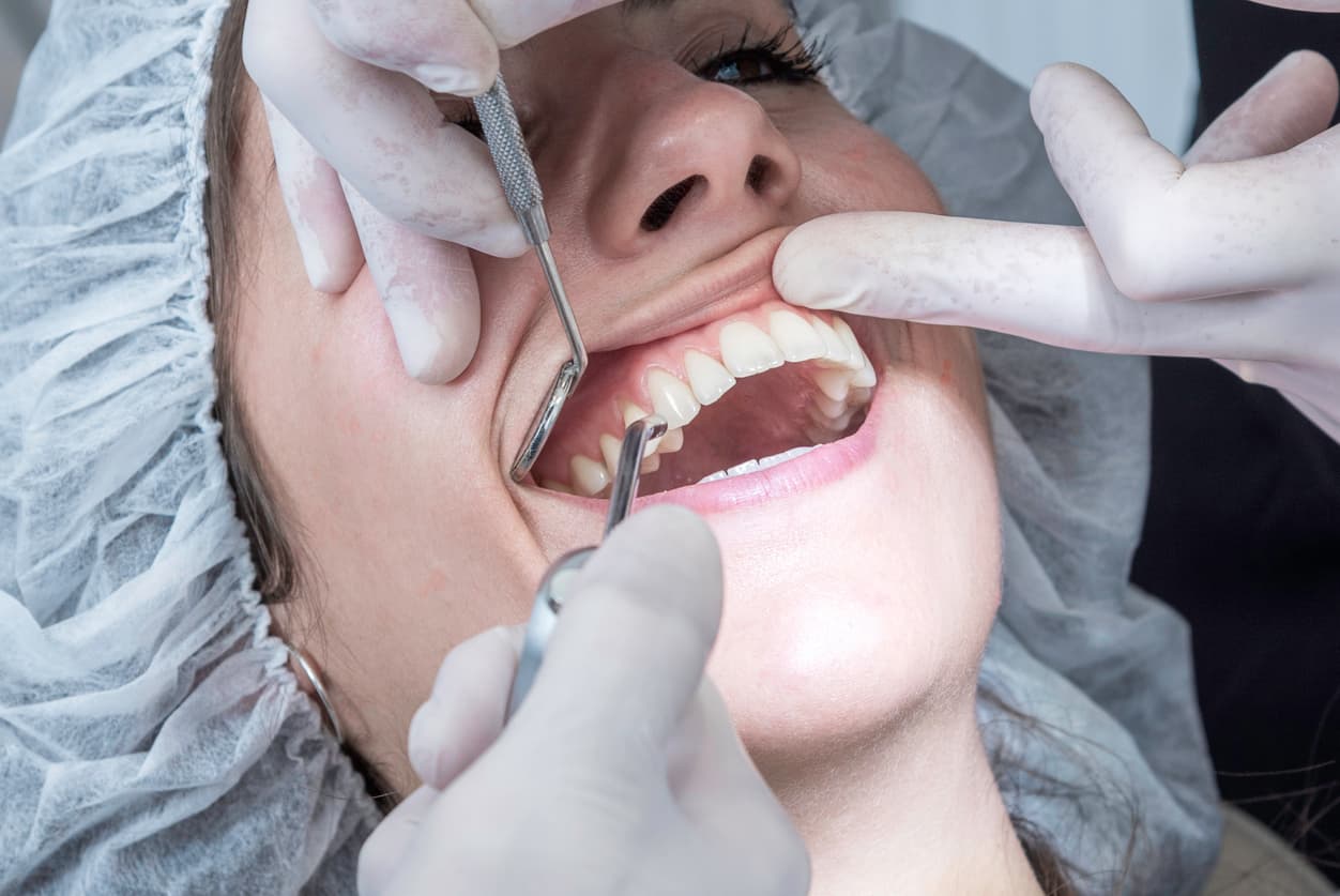 Gingivectomy