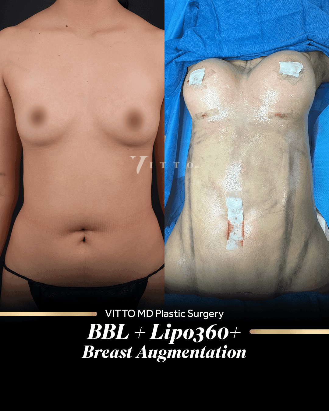 Before and after result at VittoMD in Miami, FL