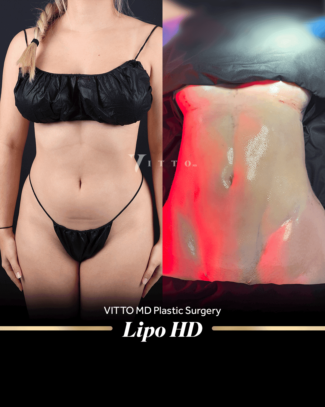 Resultados de Lipo 360 - 1