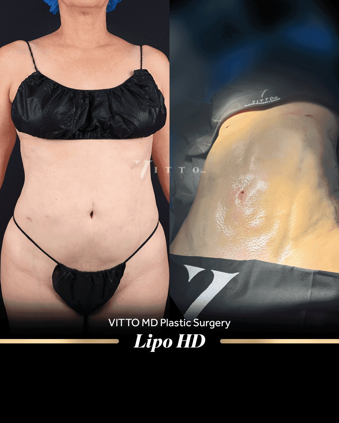Before and after result at VittoMD in Miami, FL