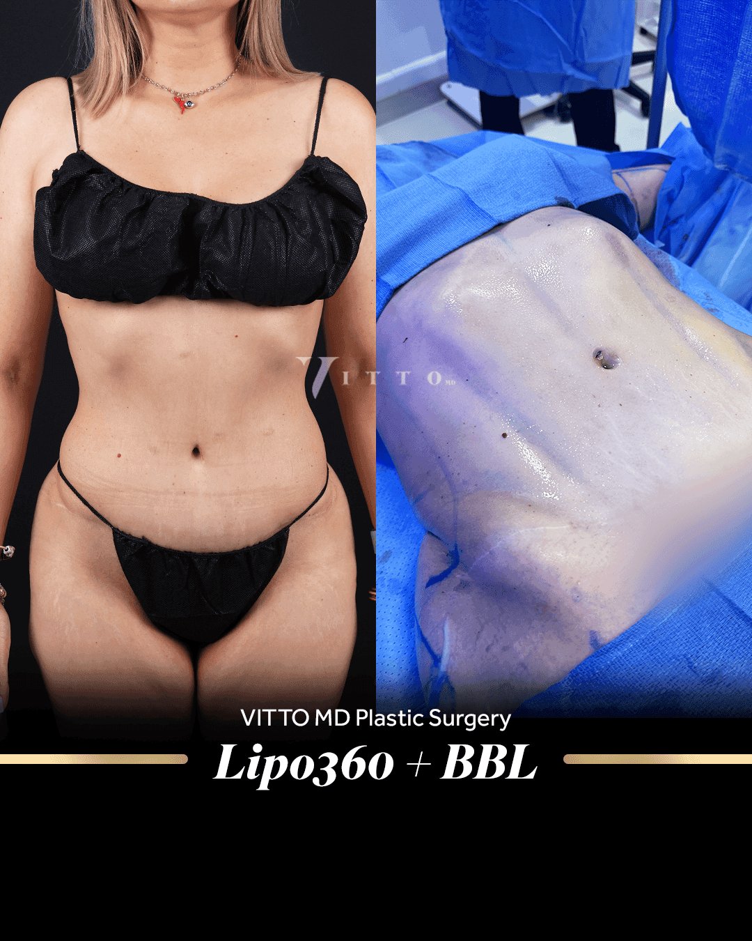 Before and after result at VittoMD in Miami, FL