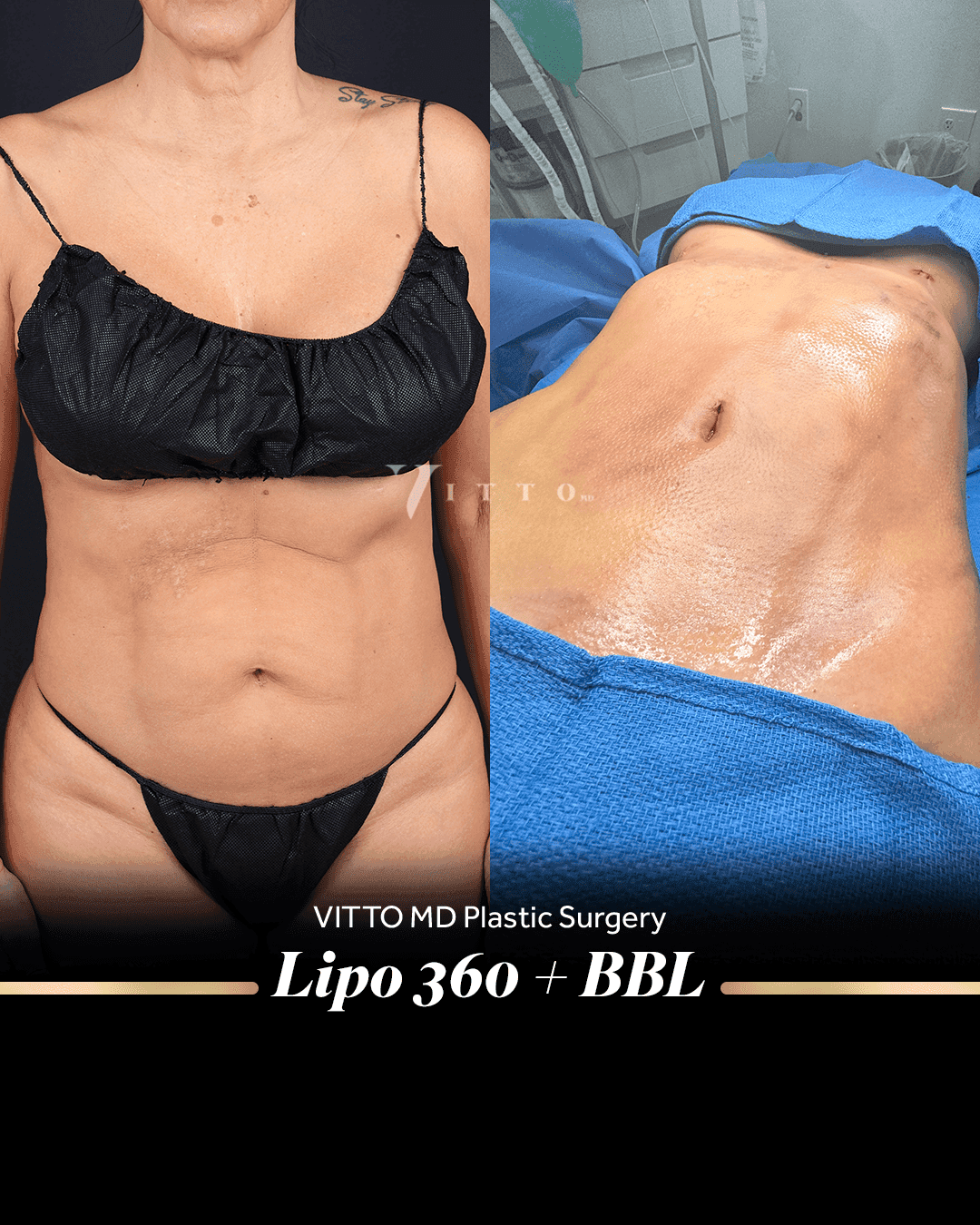 Before and after result at VittoMD in Miami, FL