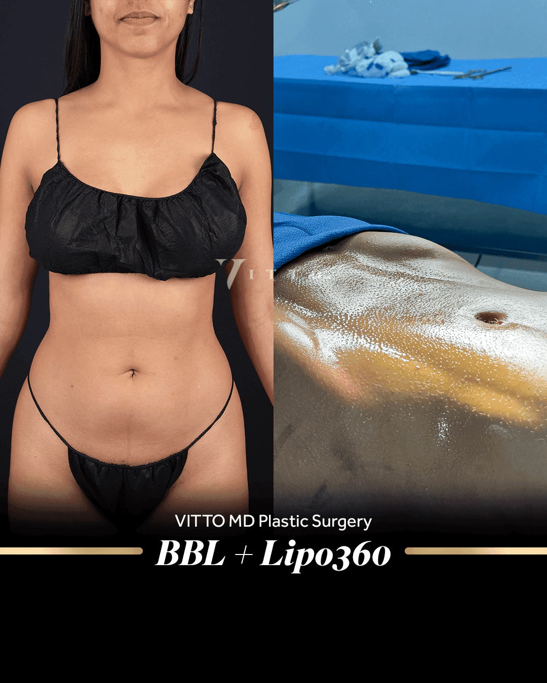 Before and after result at VittoMD in Miami, FL