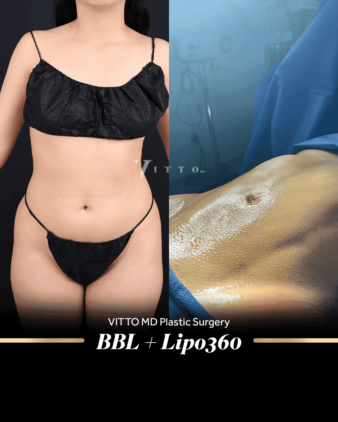 Before and after result at VittoMD in Miami, FL