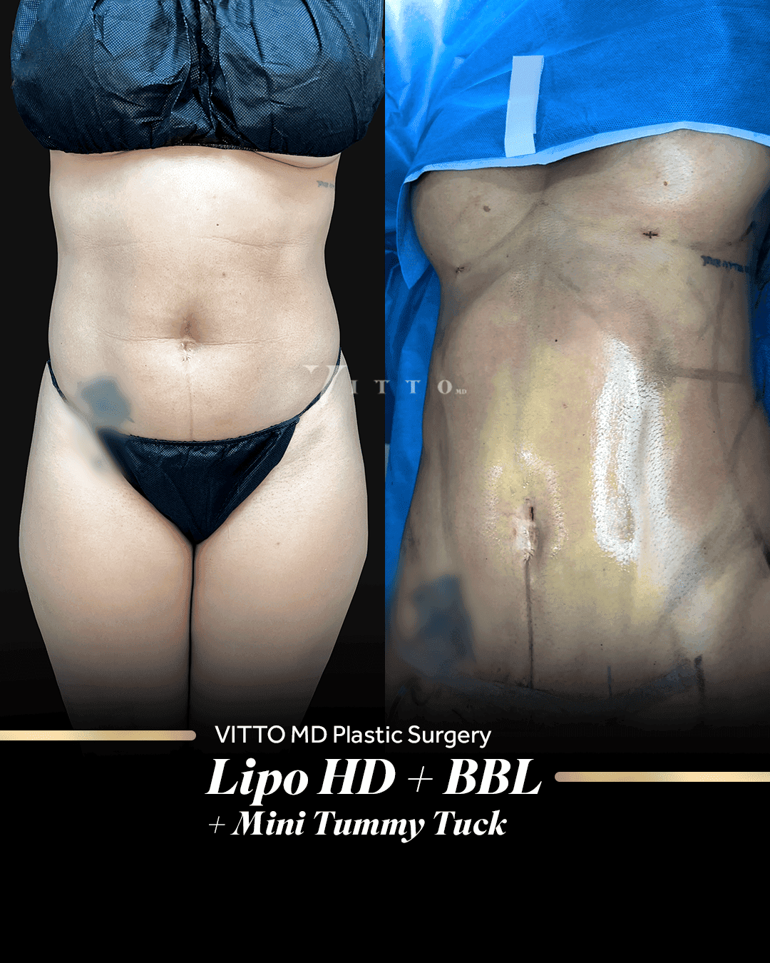 Before and after result at VittoMD in Miami, FL
