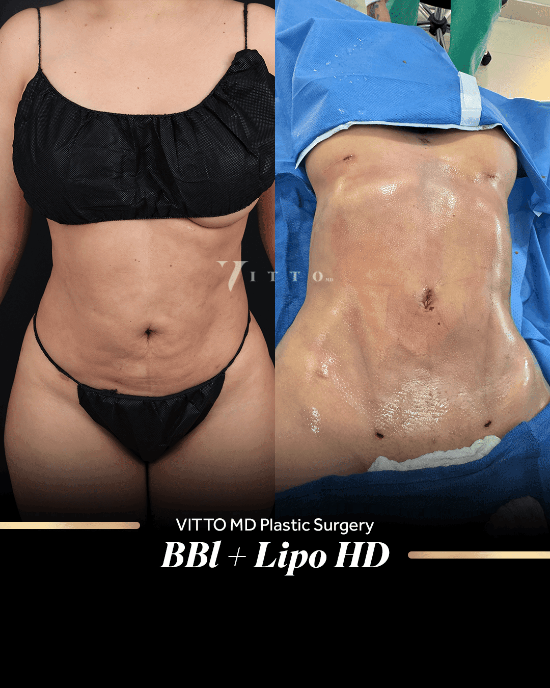 Before and after result at VittoMD in Miami, FL