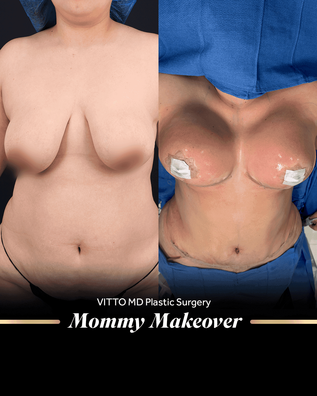 Resultados de Mommy Makeover - 1