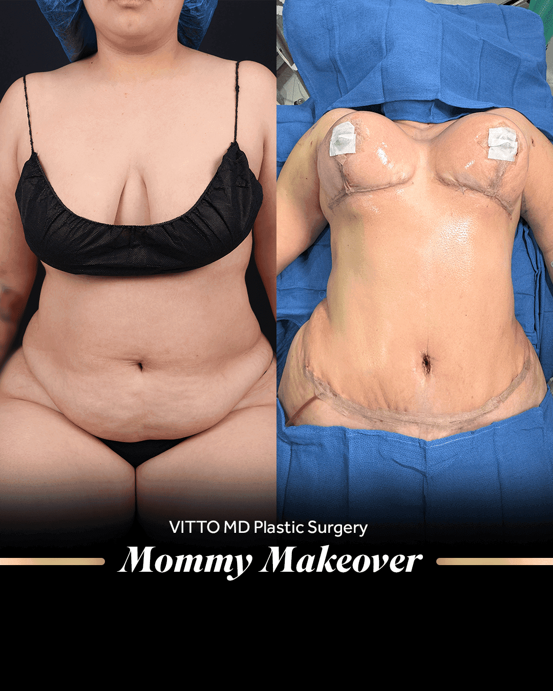 Before and after result at VittoMD in Miami, FL