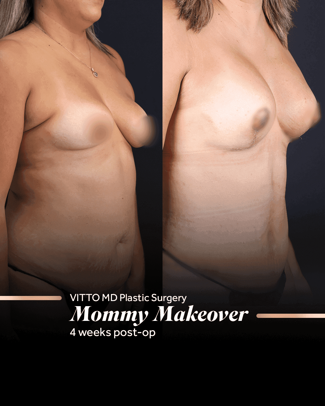 Before and after result at VittoMD in Miami, FL