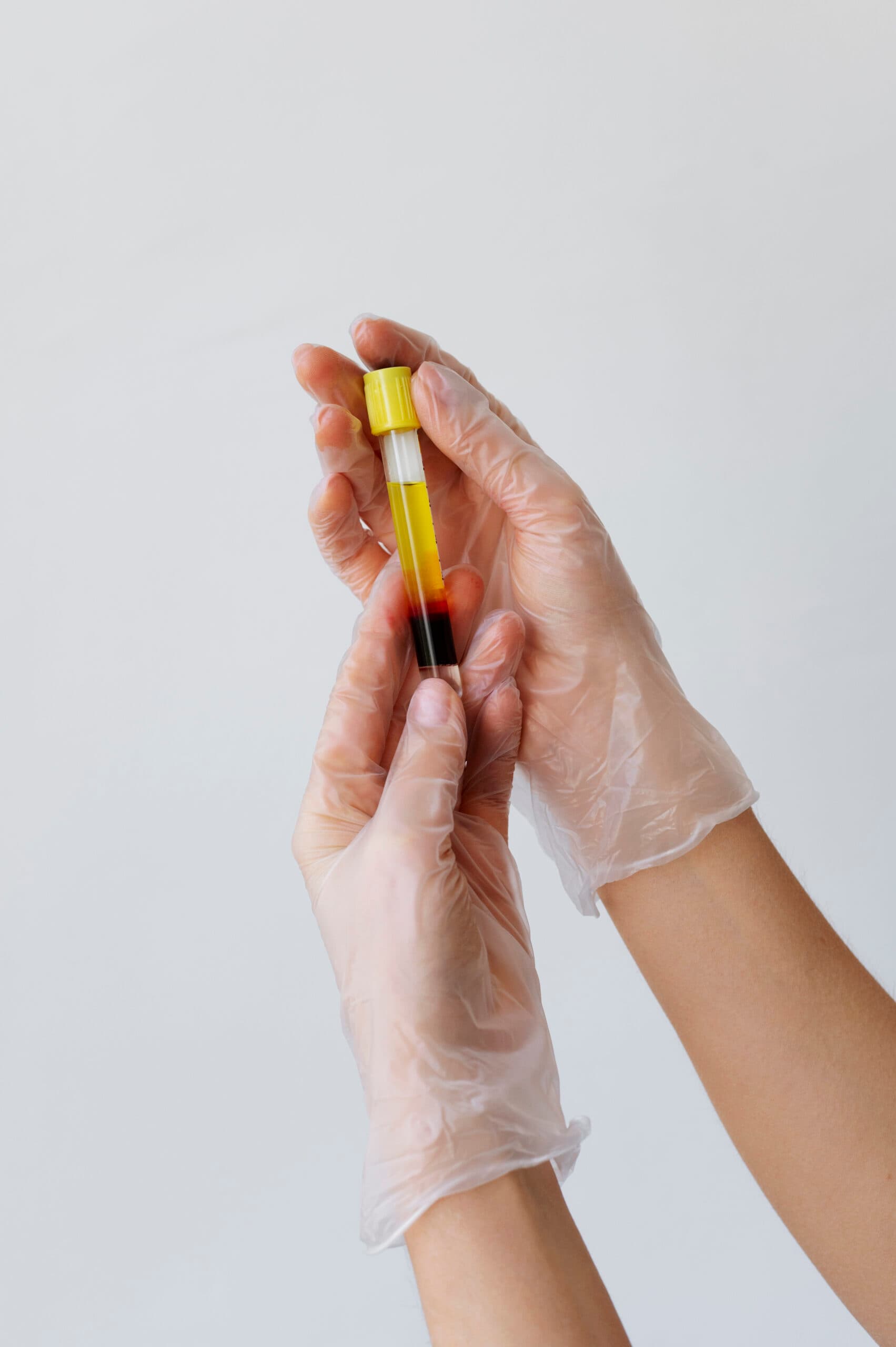 PRP Platelet Rich Plasma