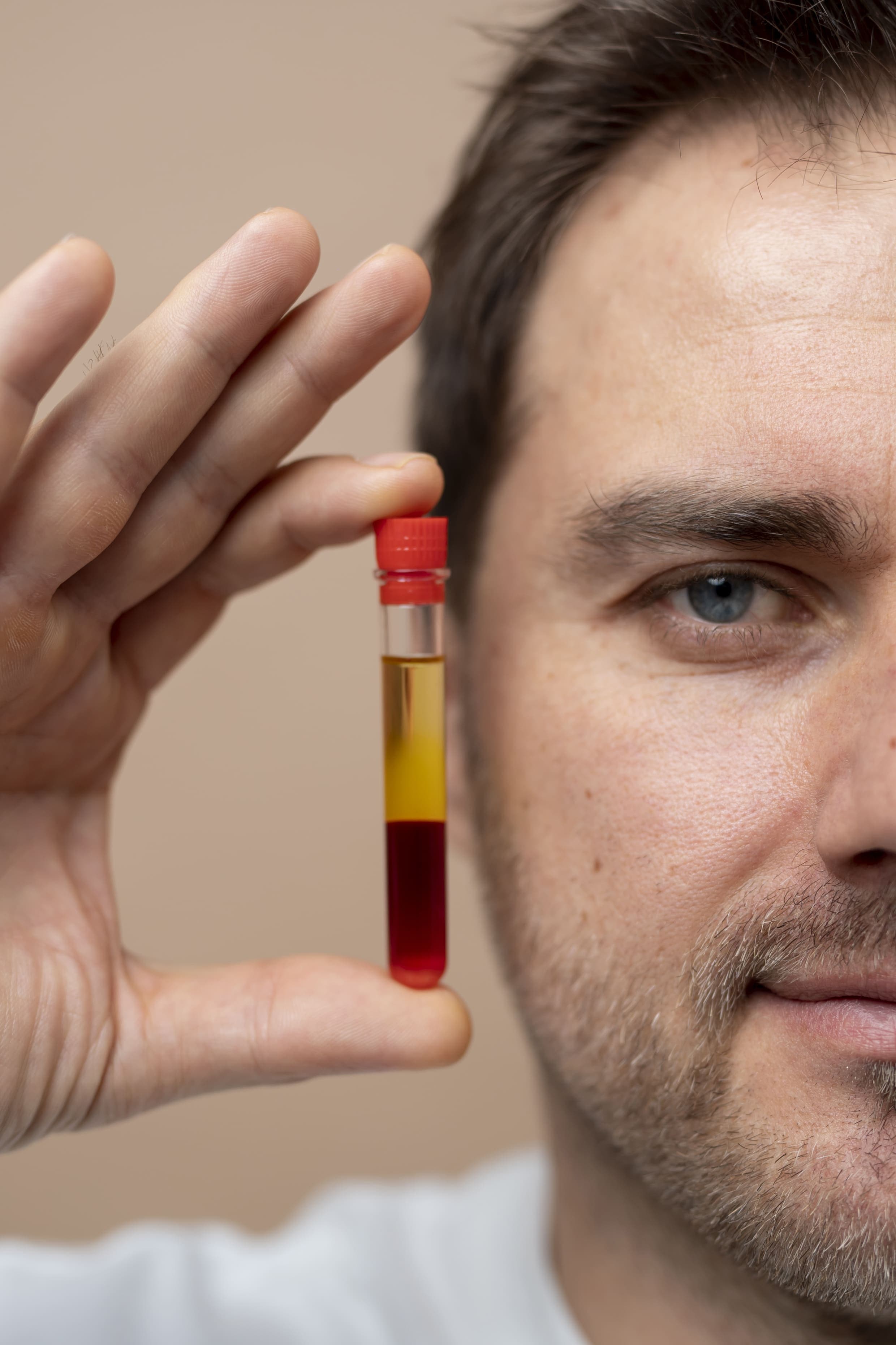 PRP Platelet Rich Plasma at VittoMD - Miami, FL