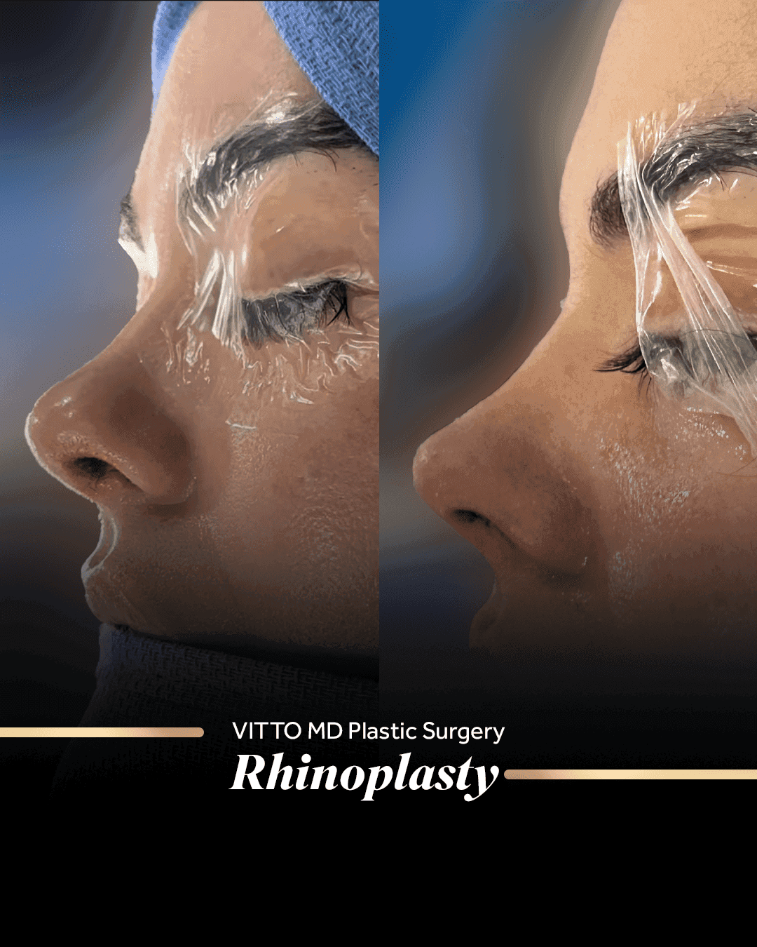 Resultados de Rhinoplasty - 1