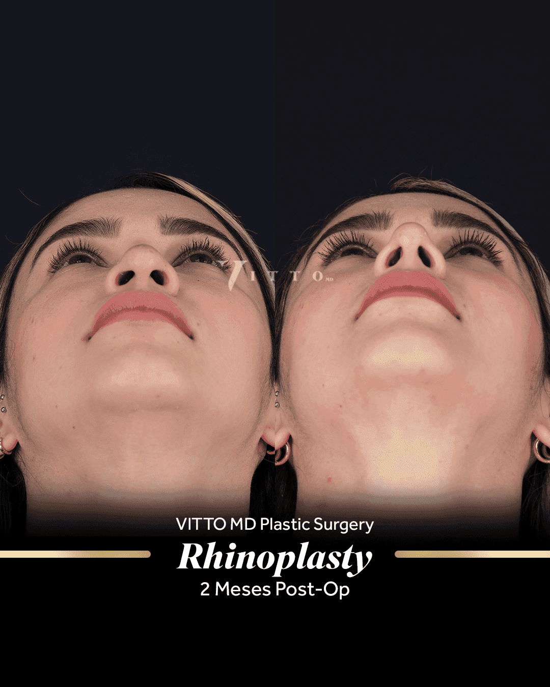 Before and after result at VittoMD in Miami, FL