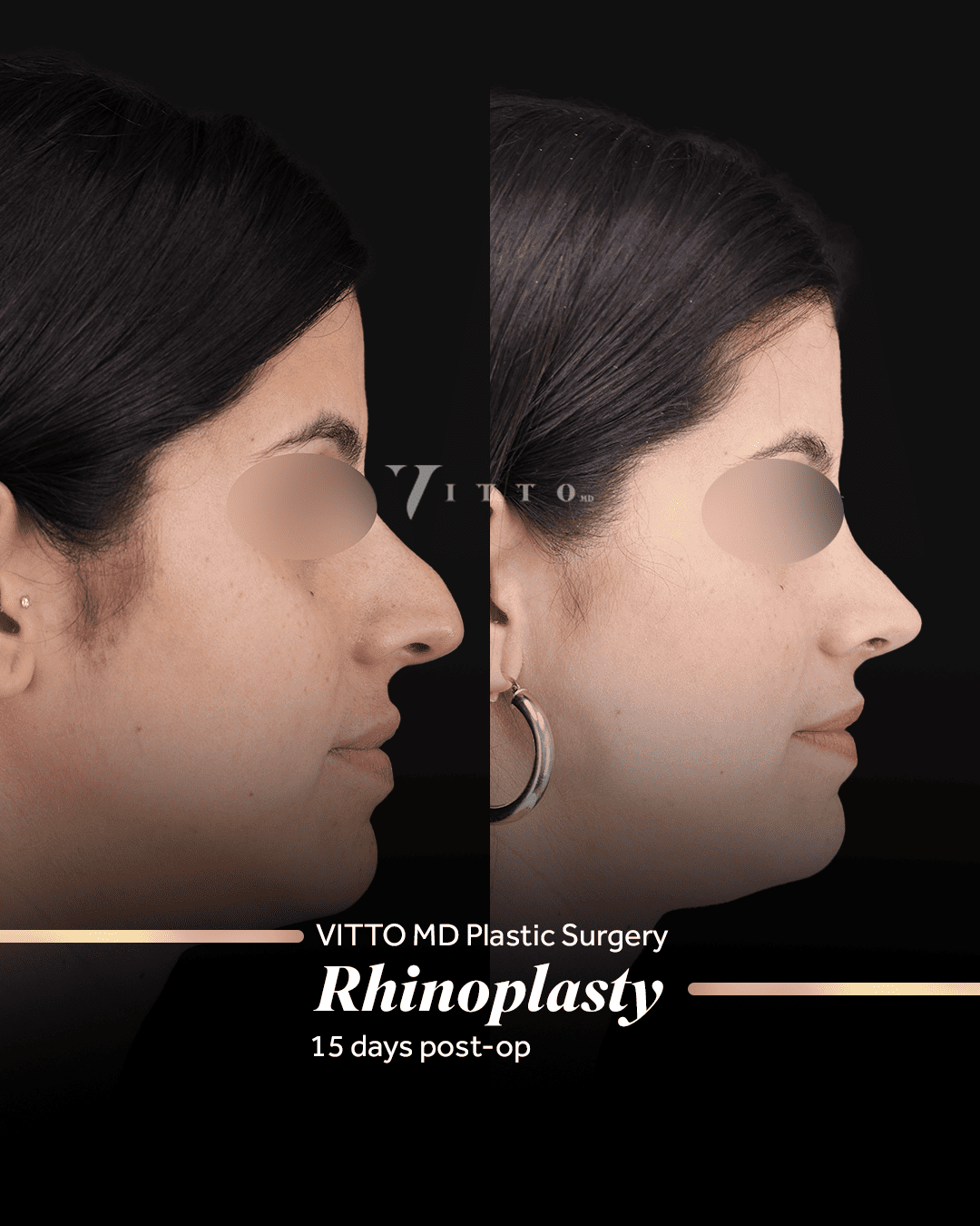 Before and after result at VittoMD in Miami, FL