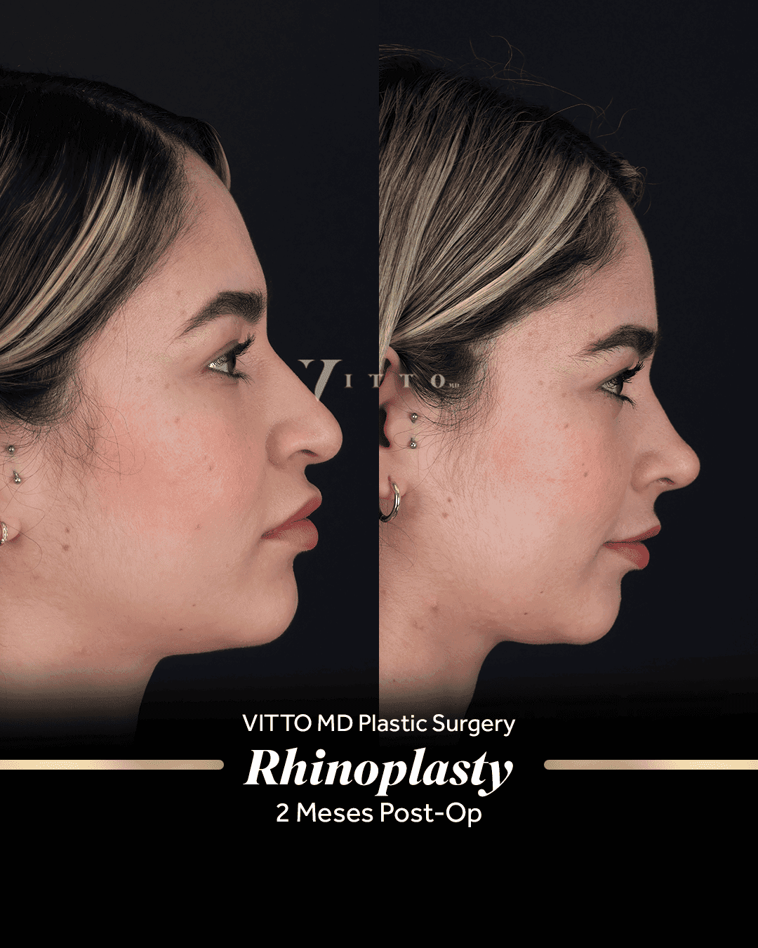 Before and after result at VittoMD in Miami, FL