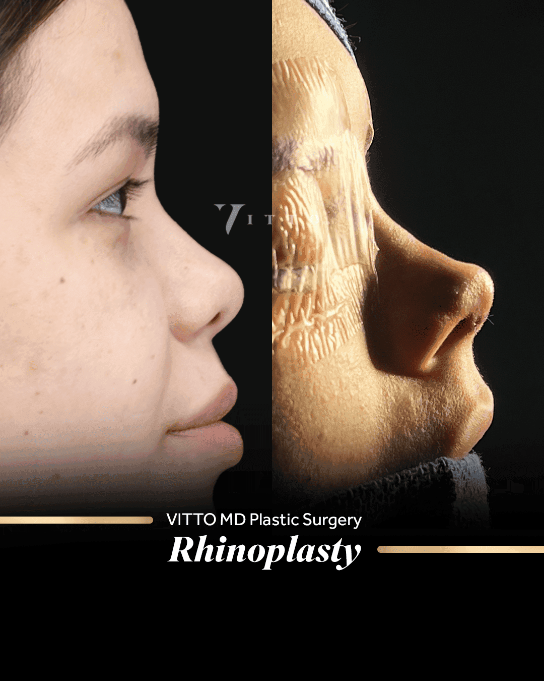 Before and after result at VittoMD in Miami, FL