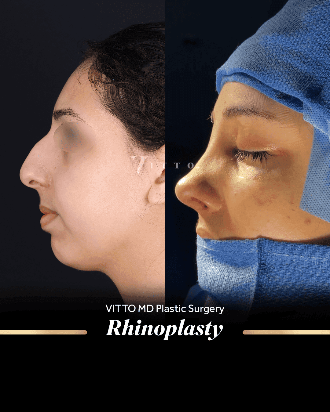 Before and after result at VittoMD in Miami, FL